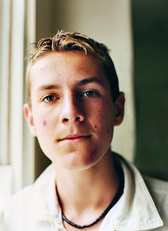 Portrait of a Male Teenager With Acne