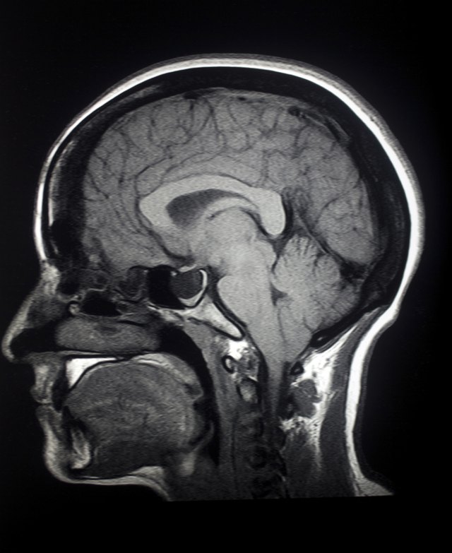 MRI Sagittal Brain