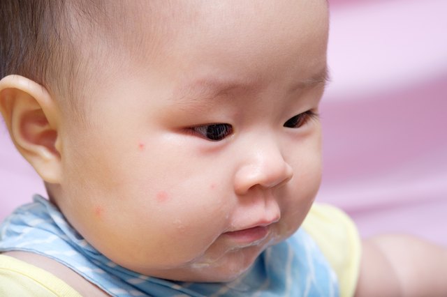 Baby Red Spots On Face And Neck