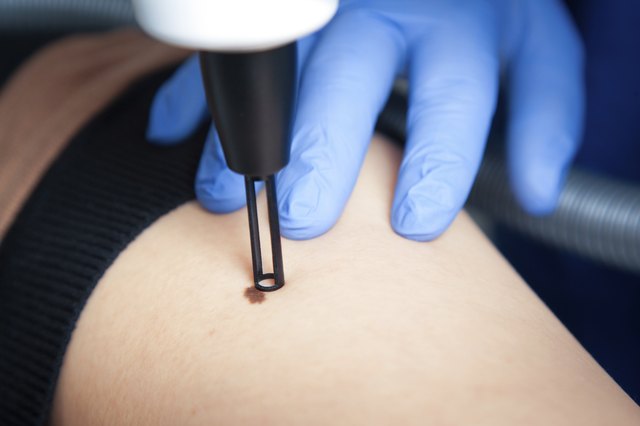 liver spot medical laser
