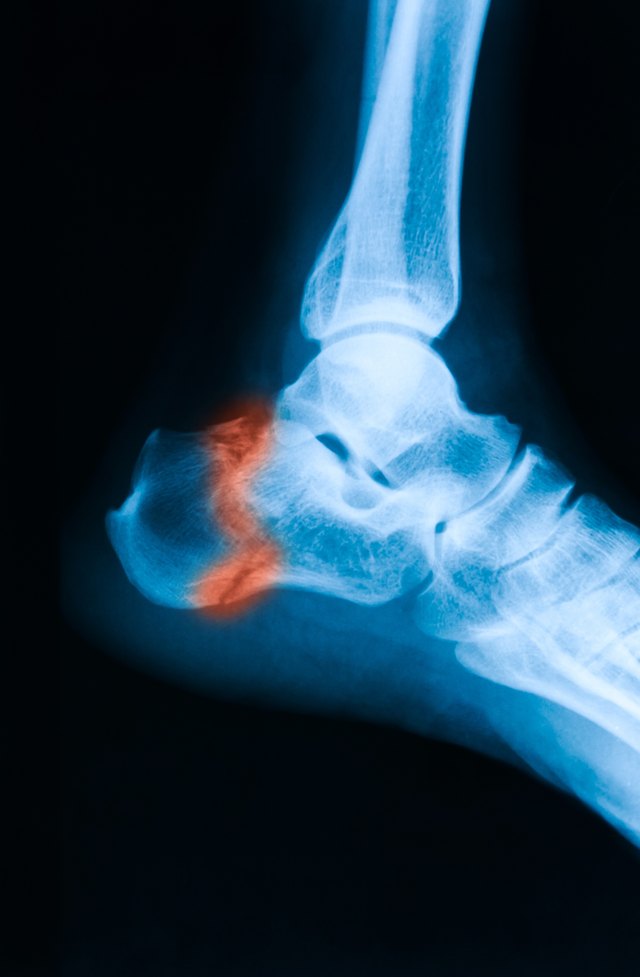 complications-of-orif-ankle-surgery-livestrong