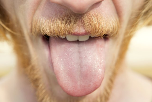 Large White Bumps On Back Of Tongue And Sore Throat