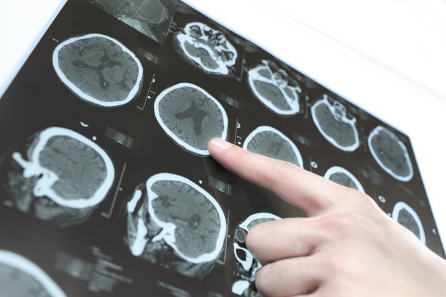 CT scan of the patient