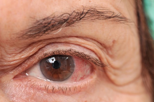 Infected eye