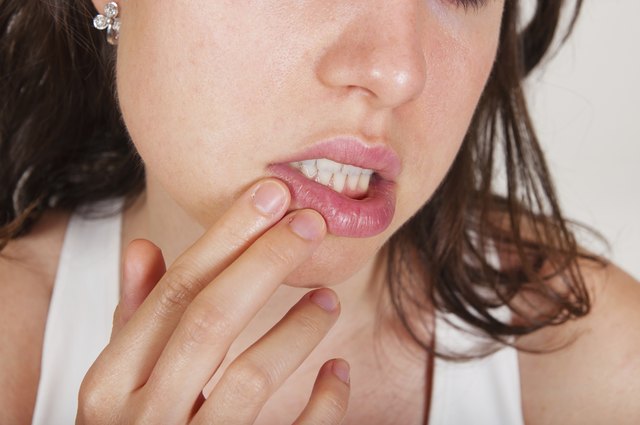 How To Treat Cold Sores When Pregnant Livestrong