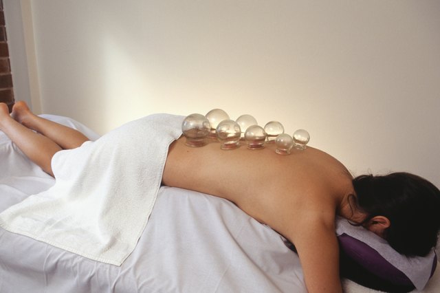Woman lying face down having cupping acupuncture