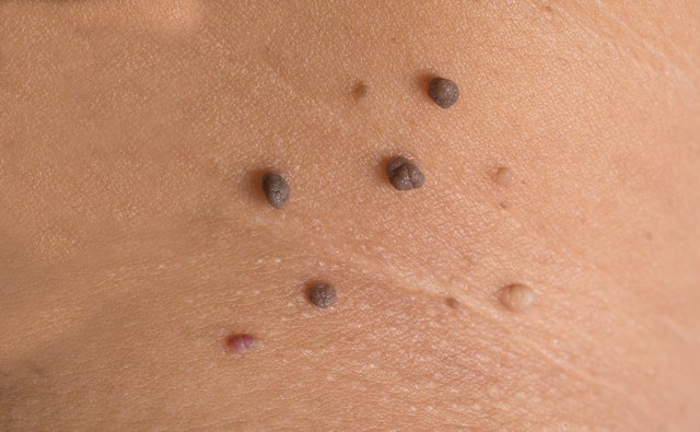 skin of a woman with moles