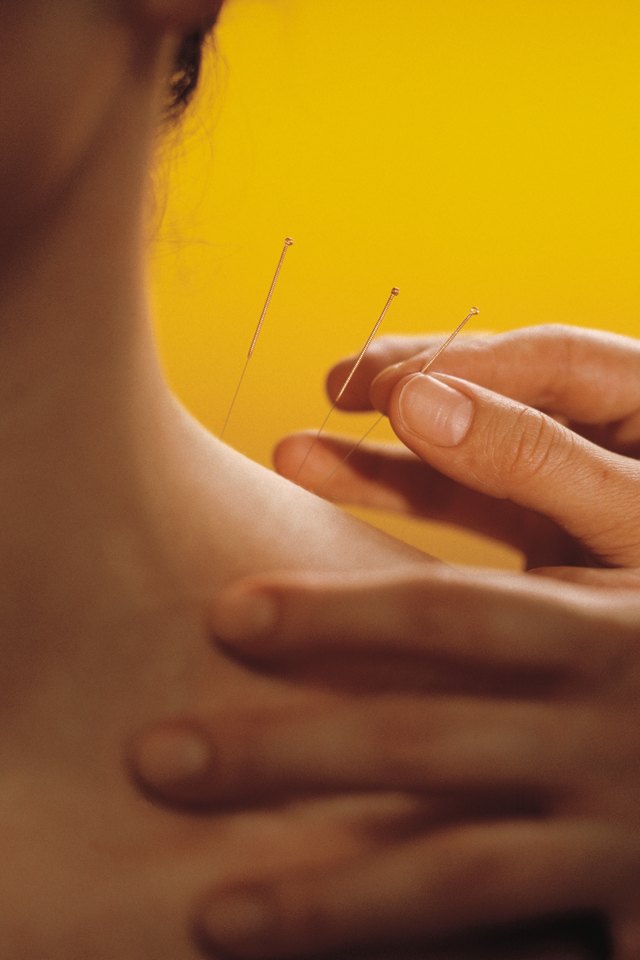 Can Acupuncture Damage Nerves? | Livestrong.com