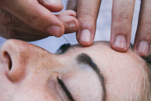 Physiotherapist doing acupuncture on a patient brow
