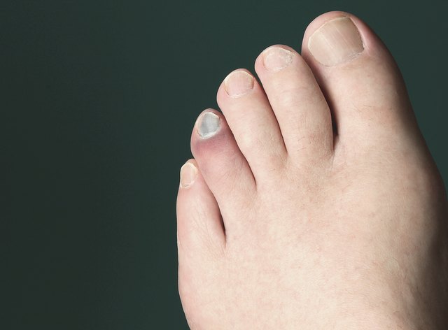 How To Know If You Ve Broken Your Toe