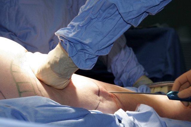 cosmetic liposuction surgery