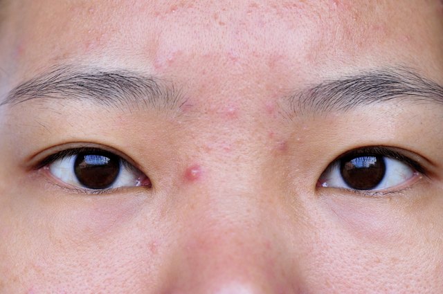 acne on face