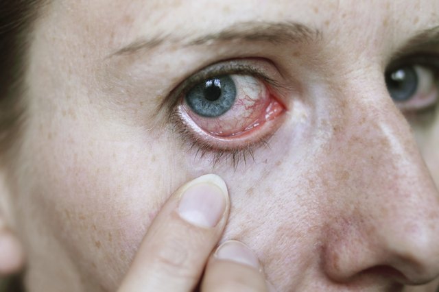 red eye after hayfever attack