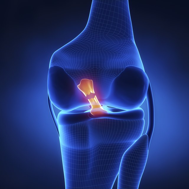 Torn Anterior Cruciate Ligament