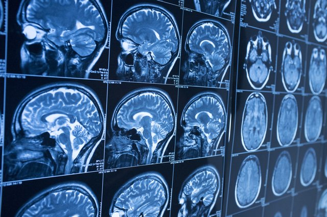 Head x-ray, brain in MRI