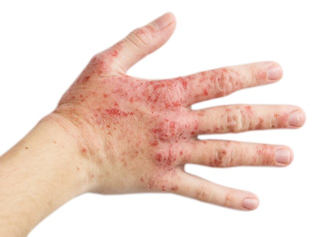 Eczema on a female hand