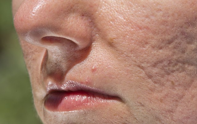 Pimple and acne scars