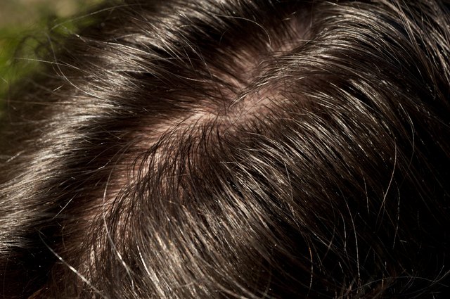 Greasy Hairline
