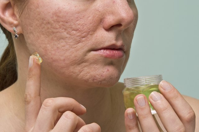 Acne therapy