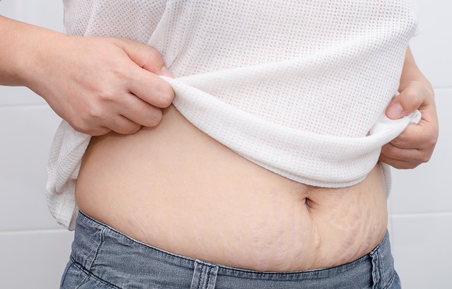 woman showing her stretch marks