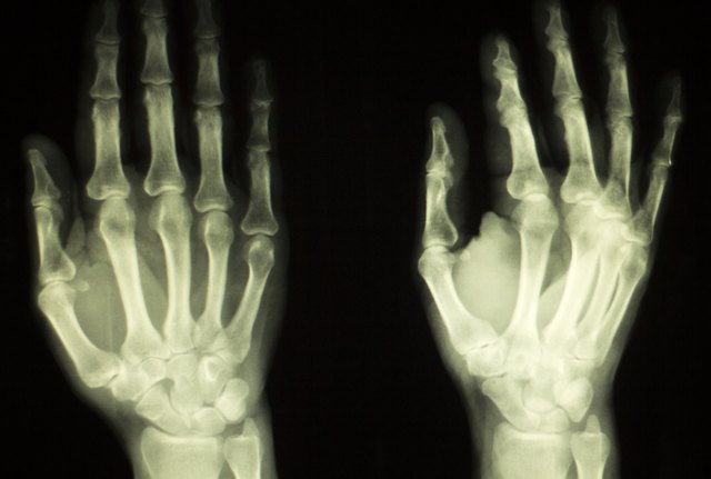 What To Do When You Have Swollen Finger Joints