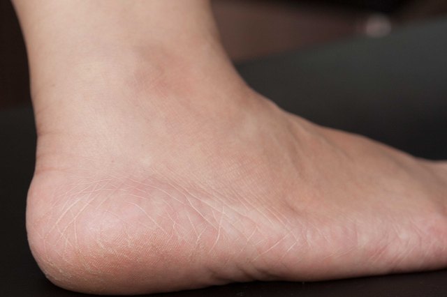 Home Remedies for Extremely Dry Feet | Livestrong.com