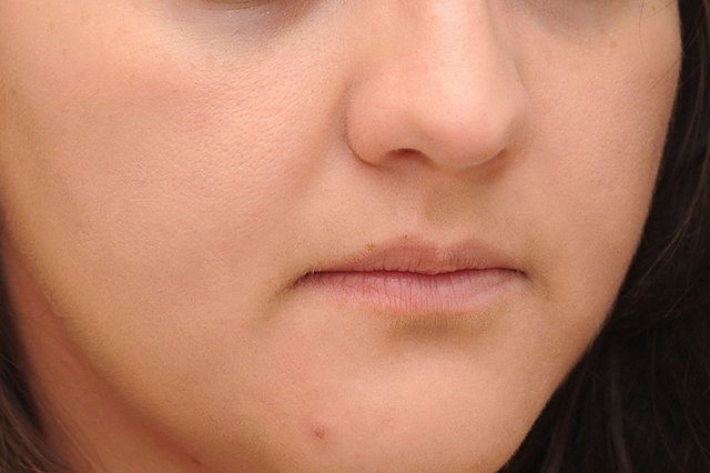 how-to-get-rid-of-popped-zits-fast-livestrong