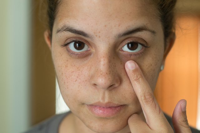 Home Remedies For Dark And Dry Skin Around The Eyes 