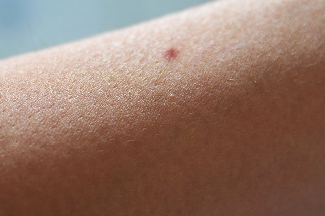 how-to-remove-ingrown-arm-hair-livestrong