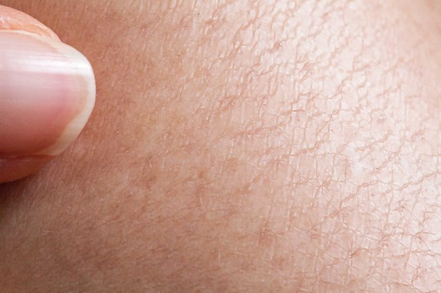 Natural Remedies for Extremely Dry Skin | Livestrong.com
